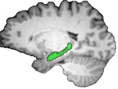 Scan of brain with hippocampus highlighted in green